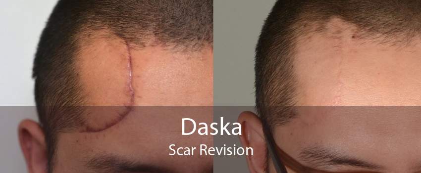 Daska Scar Revision