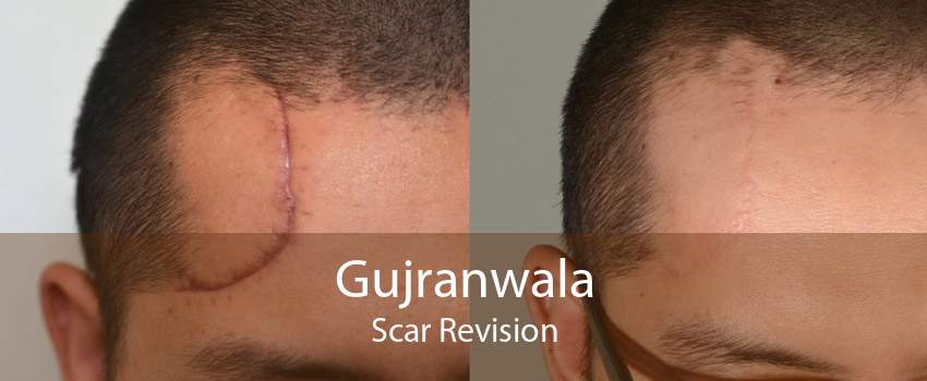 Gujranwala Scar Revision