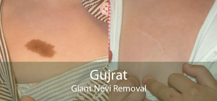 Gujrat Giant Nevi Removal
