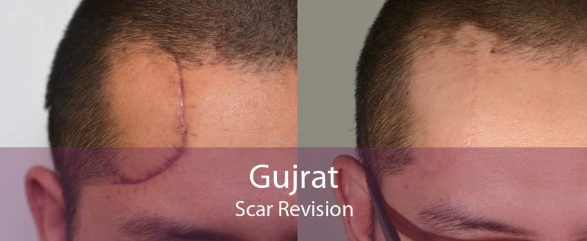Gujrat Scar Revision