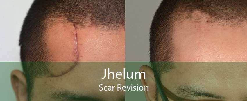 Jhelum Scar Revision