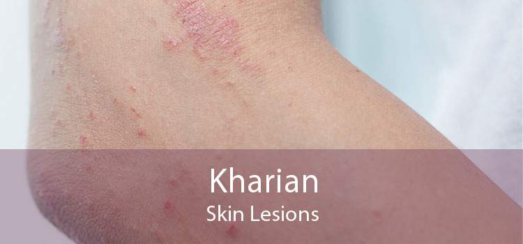 Kharian Skin Lesions