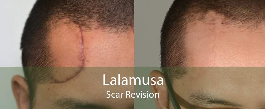 Lalamusa Scar Revision