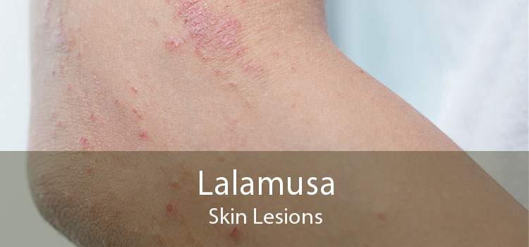 Lalamusa Skin Lesions