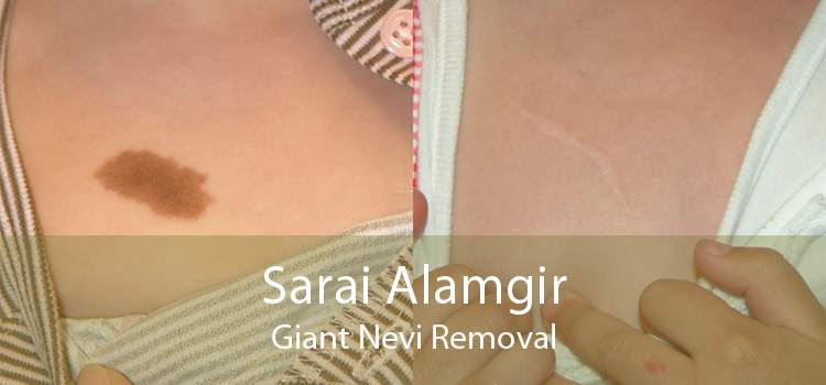 Sarai Alamgir Giant Nevi Removal