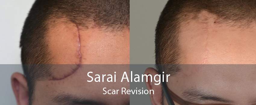 Sarai Alamgir Scar Revision