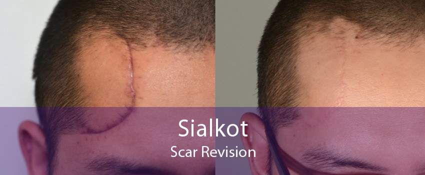 Sialkot Scar Revision