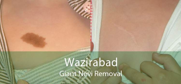 Wazirabad Giant Nevi Removal