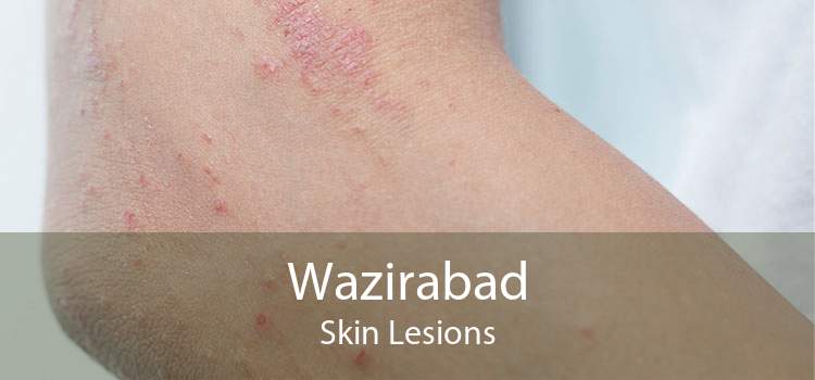Wazirabad Skin Lesions