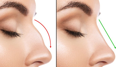 Nose Surgery 