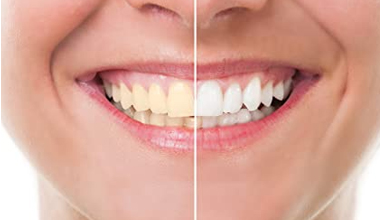  Teeth Whitening