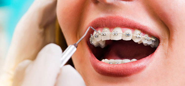 orthodontics-Special-fixed-appliances