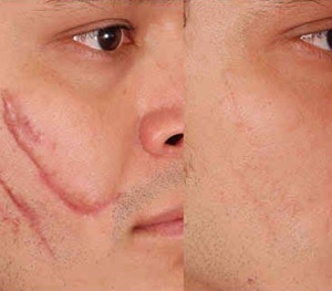 scar revision in Gujrat